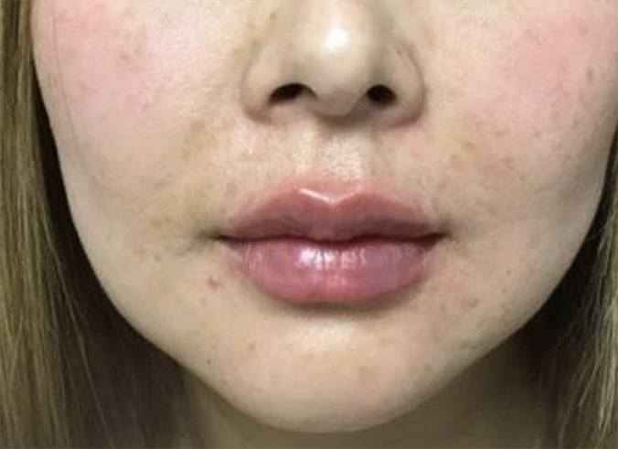 After Image: Restylane Kysse - front