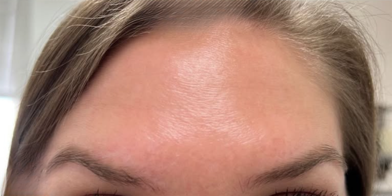 After Image: Botox - front