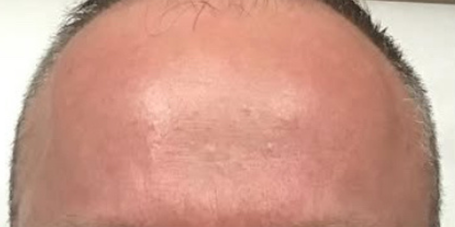 After Image: Botox - front