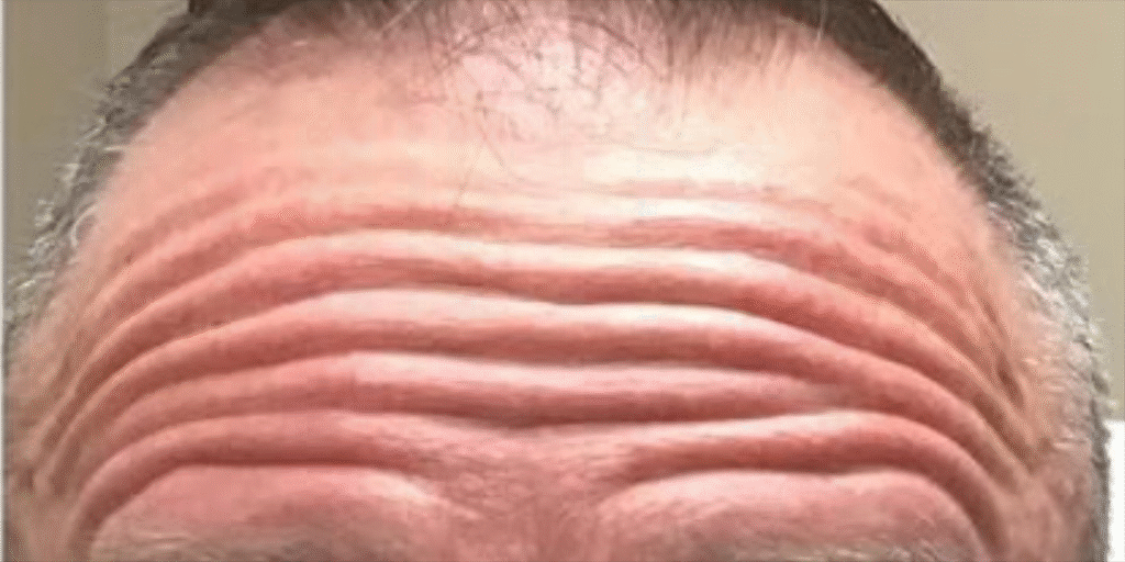 Before Image: Botox - front