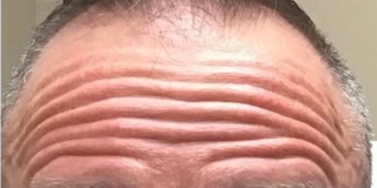 Before Image: Botox - front