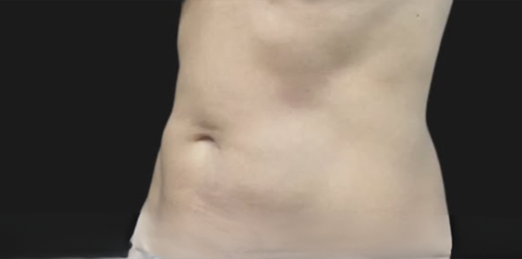 After Image: CoolSculpting - left-front-oblique
