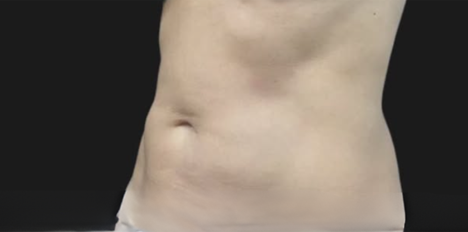 After Image: CoolSculpting - left-front-oblique