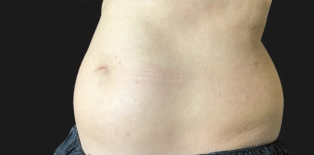 Before Image: CoolSculpting - left-front-oblique