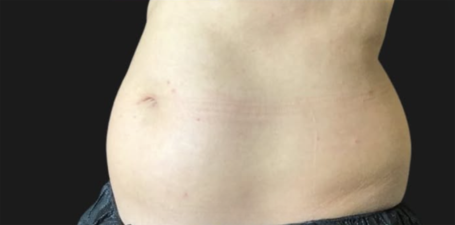 Before Image: CoolSculpting - left-front-oblique