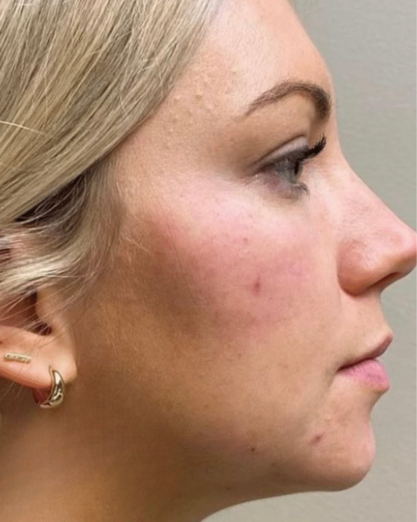 After Image: Facial Rejuvenation - right-side