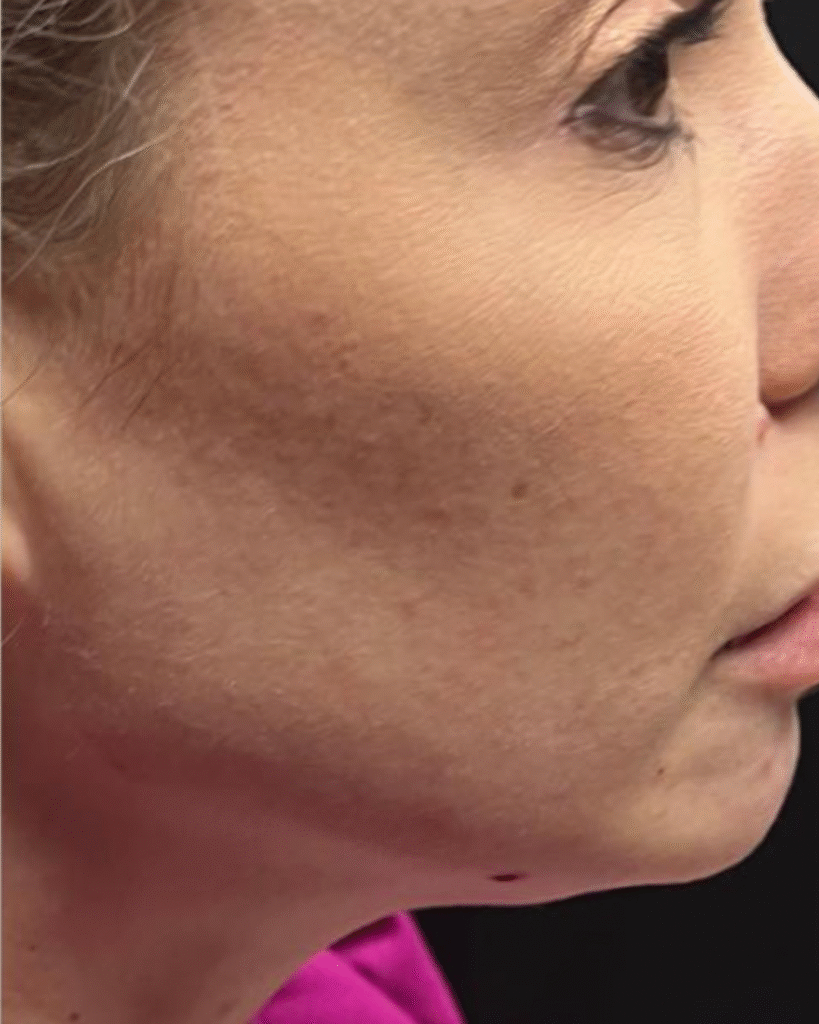 After Image: Juvederm Voluma and Volux - right-side