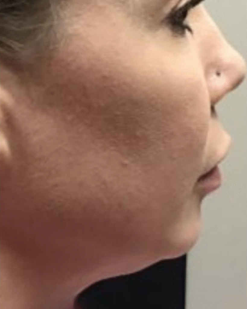 Before Image: Juvederm Voluma and Volux - right-side