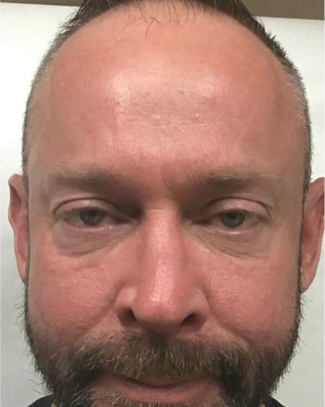 After Image: Botox – Men - front
