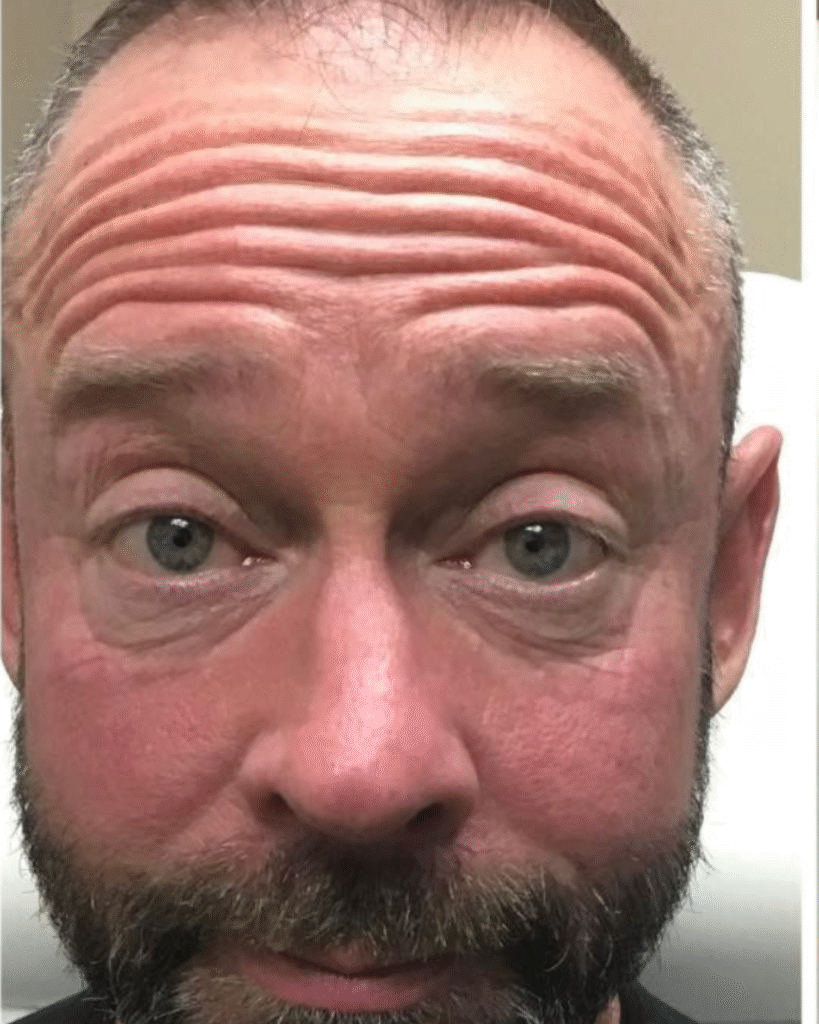 Before Image: Botox – Men - front