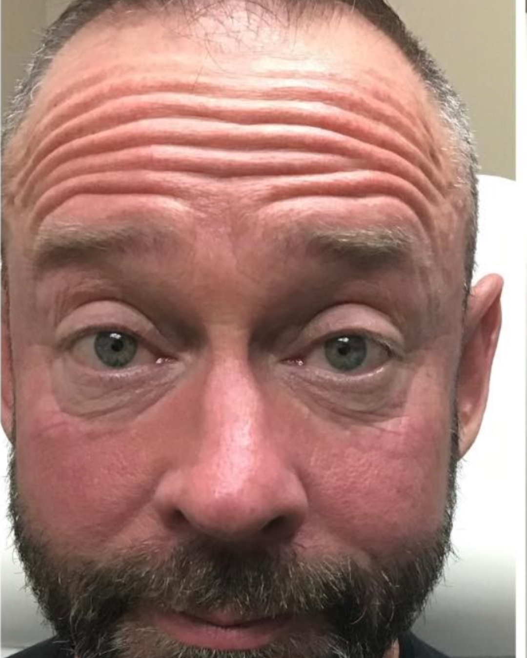 Before Image: Botox – Men - front