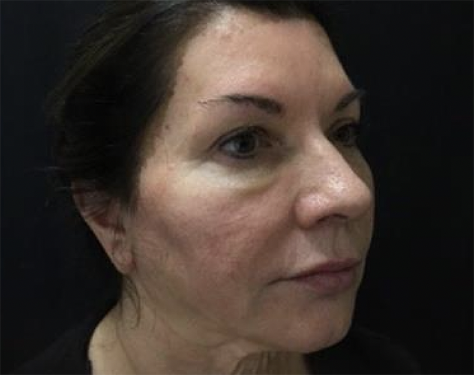 Before Image: Sculptra - front