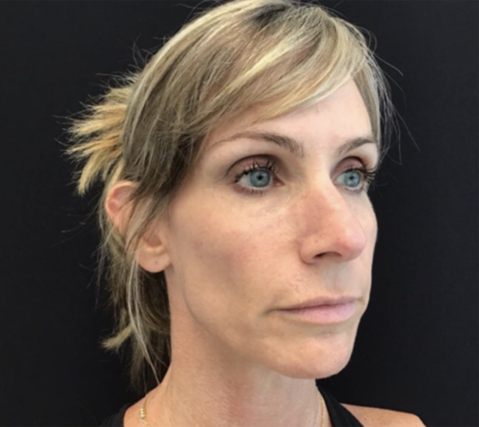 After Image: Sculptra - right-front-oblique