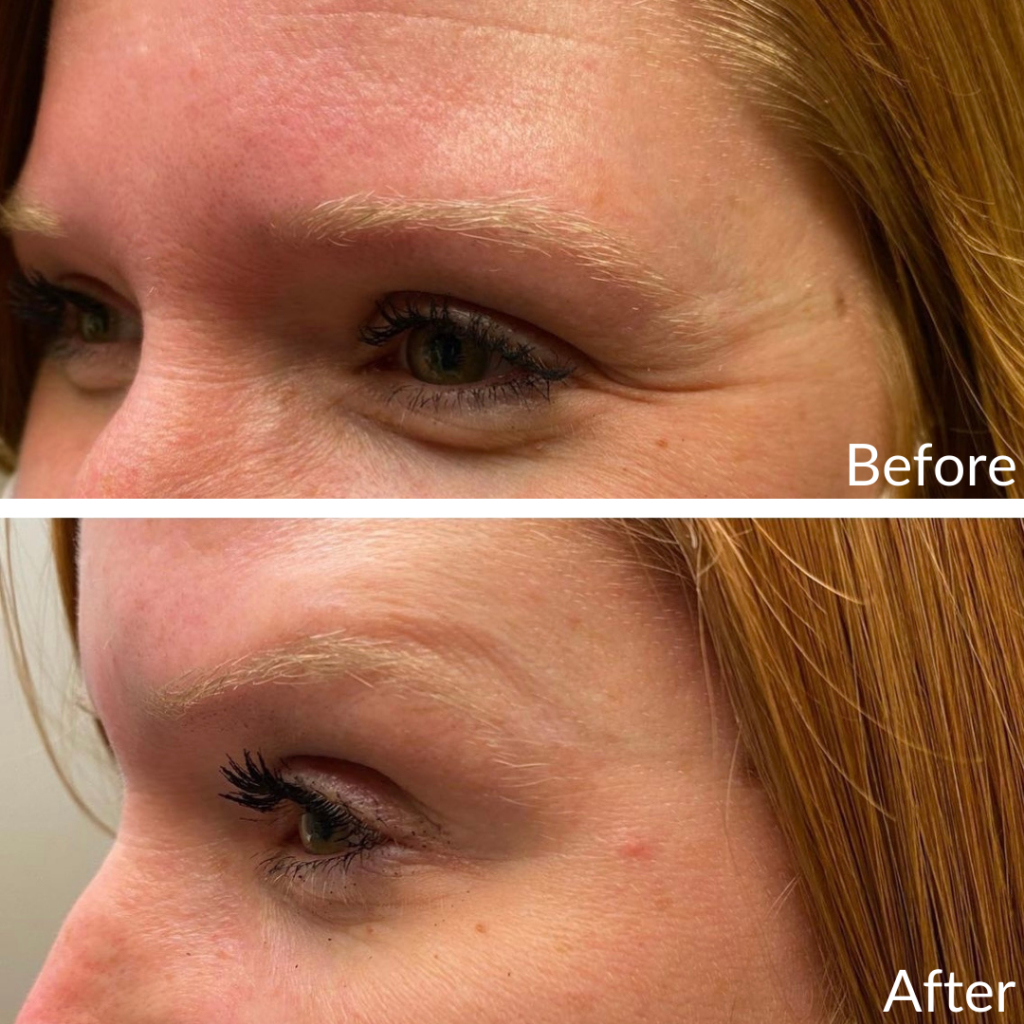 Before and After Image: Botox Crow’s Feet - left-front-oblique