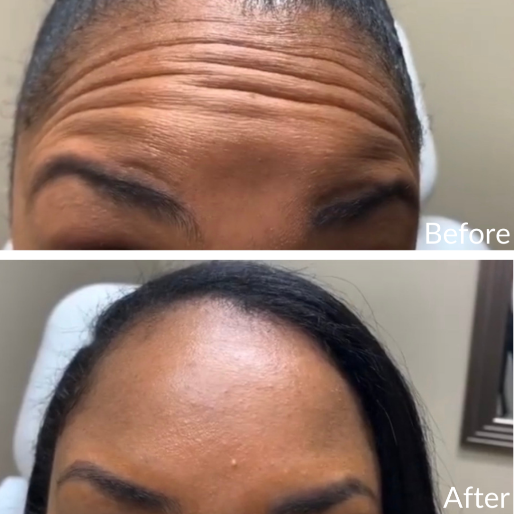 Before and After Image: Botox - front