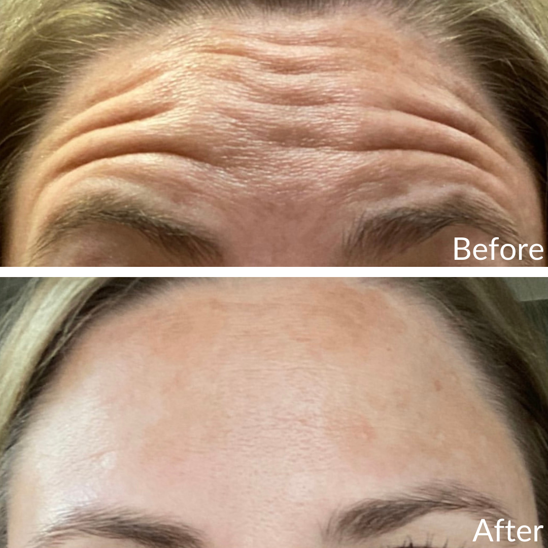 Before and After Image: Botox - front