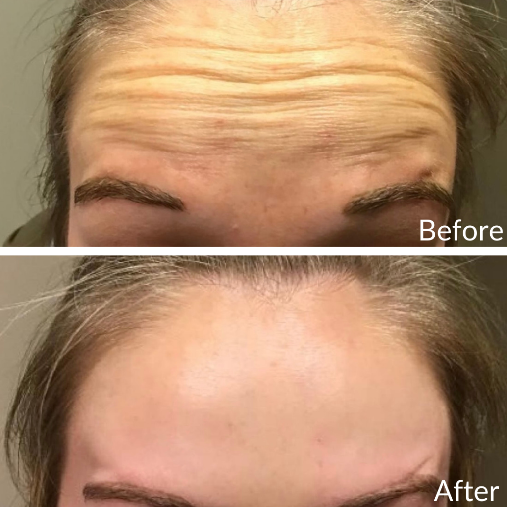 Before and After Image: Botox - front