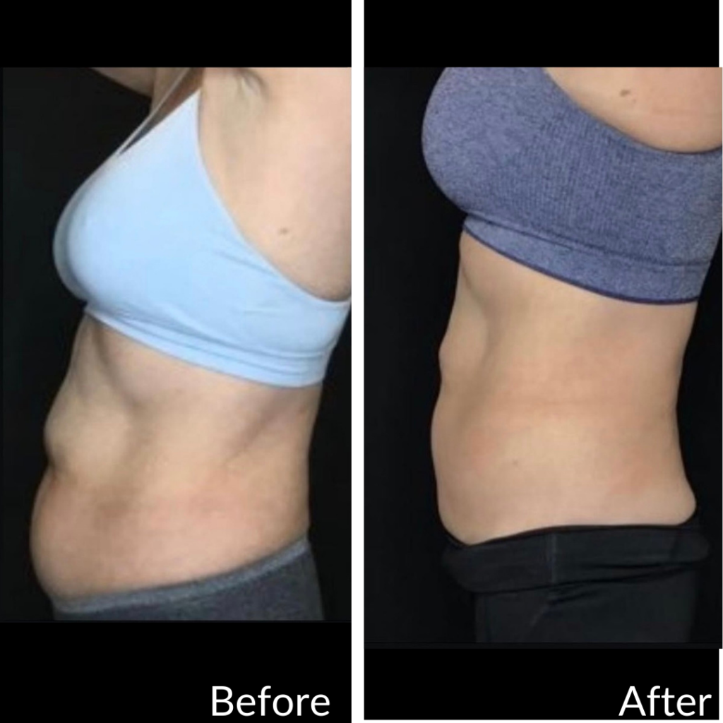 Before and After Image: CoolSculpting - left-side