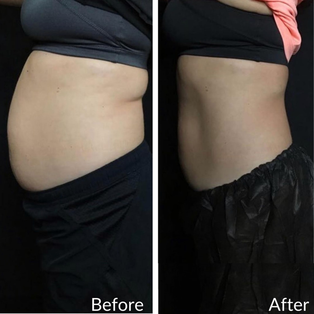Before and After Image: CoolSculpting - left-side