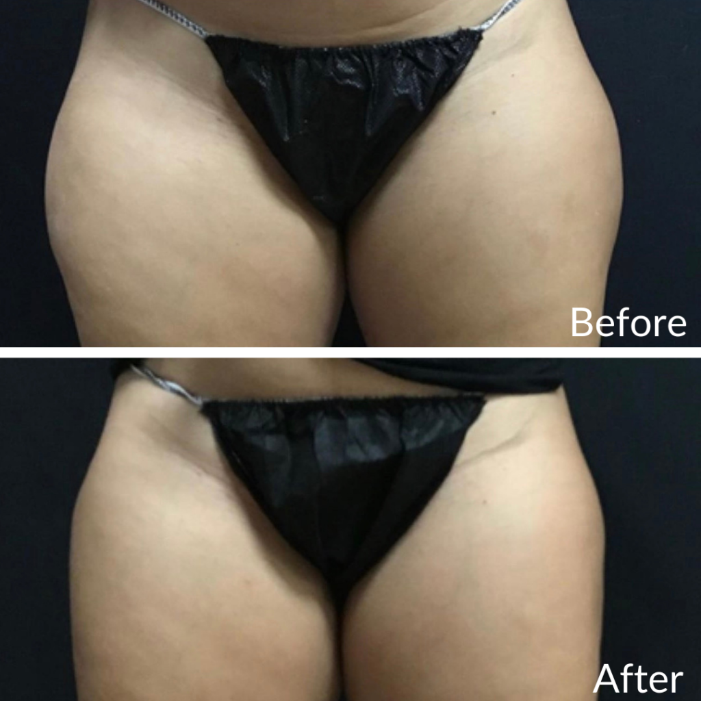 Before and After Image: CoolSculpting - front