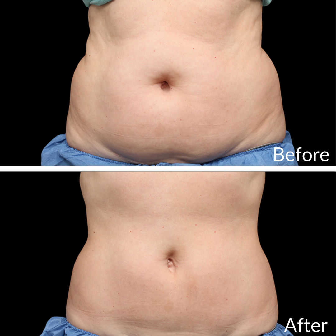 Before and After Image: CoolSculpting - front