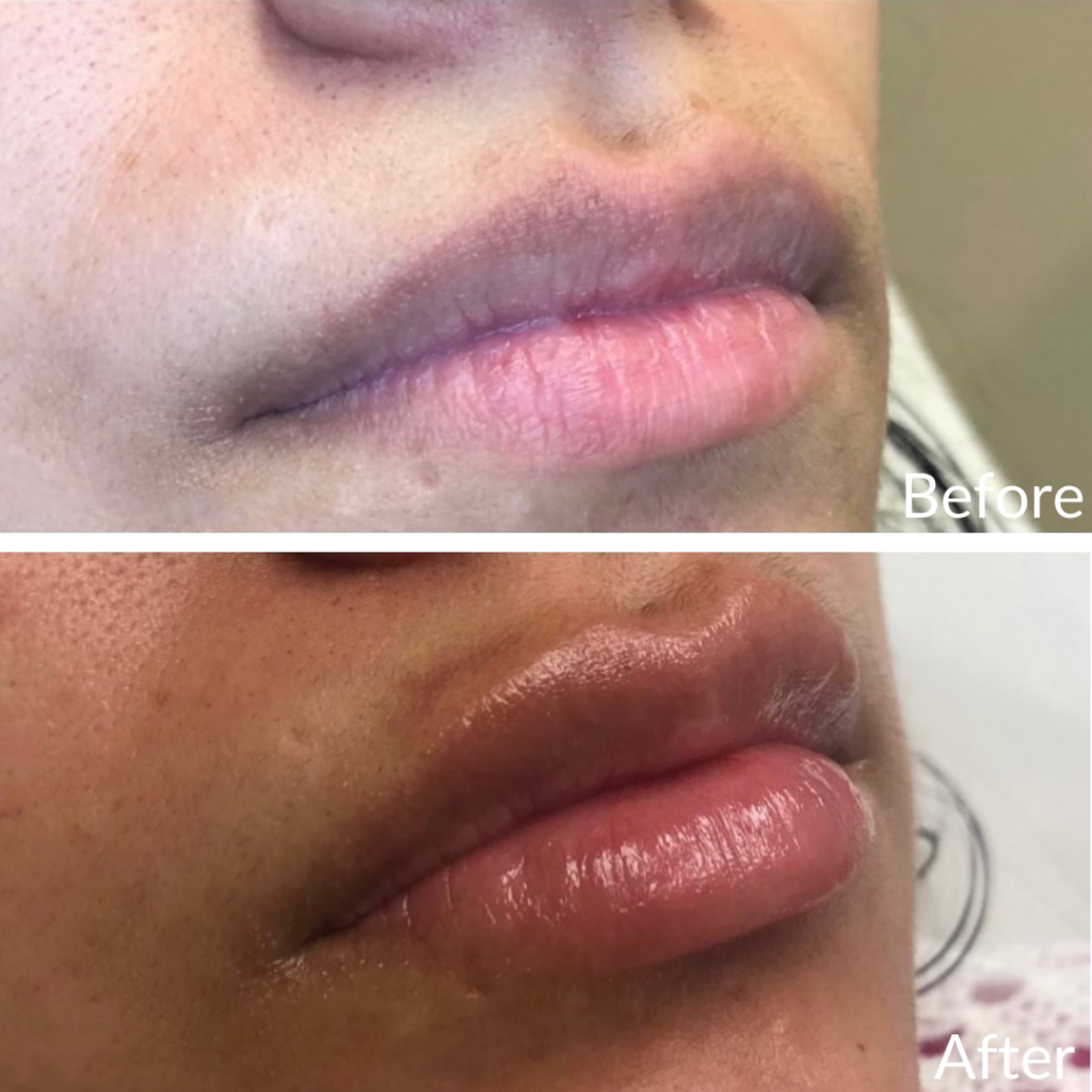 Before and After Image: Lip Filler - right-front-oblique