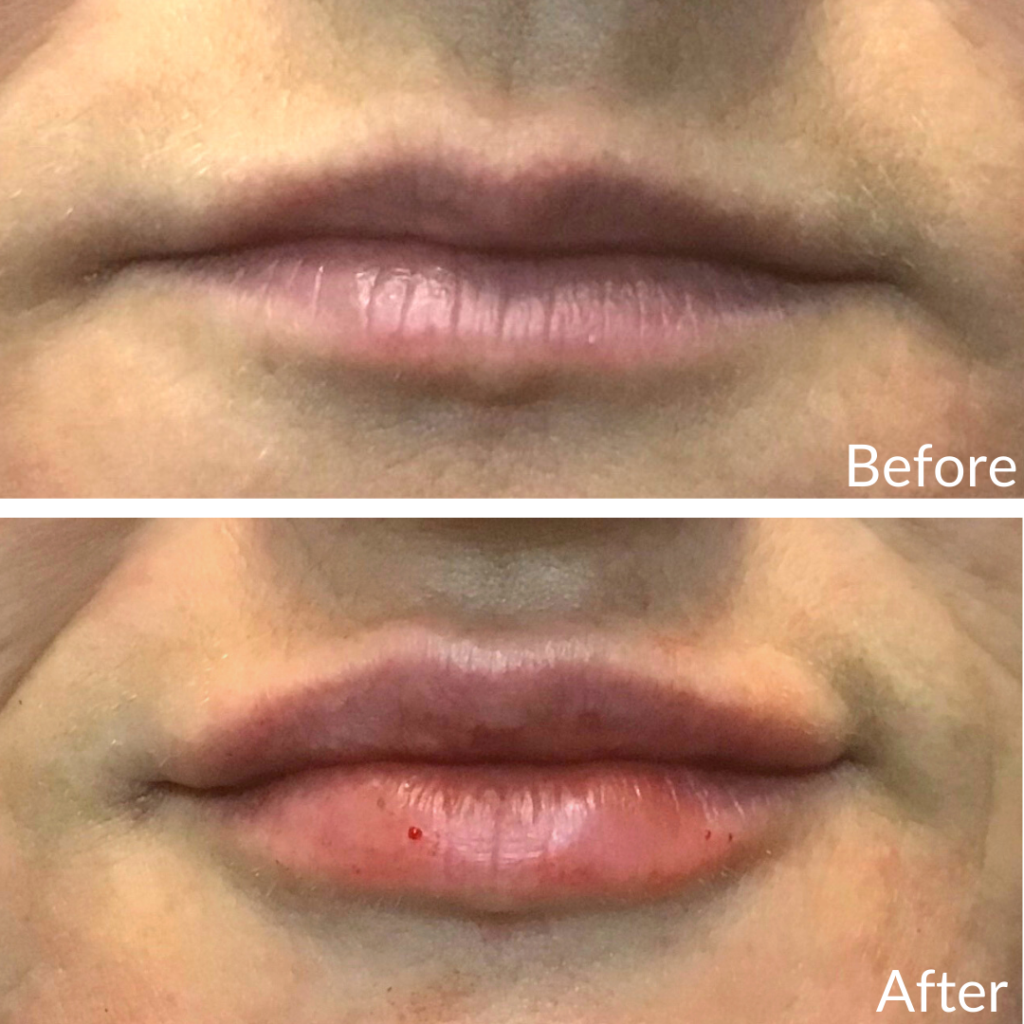 Before and After Image: Lip Filler - front