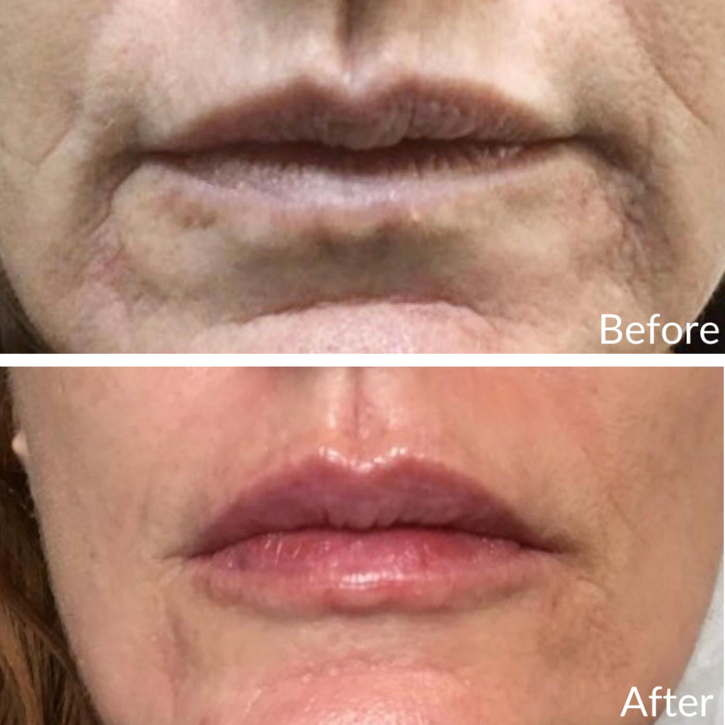 Before and After Image: Lip Filler - front