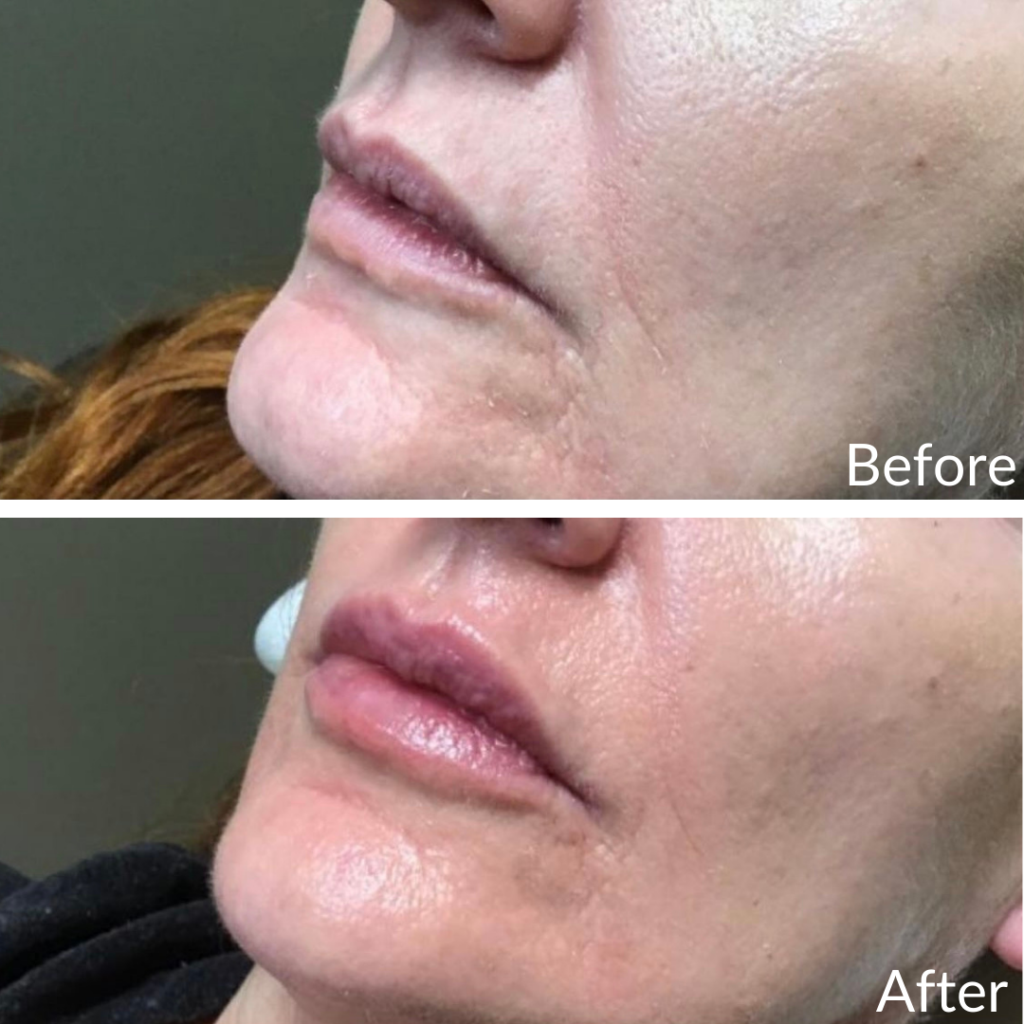Before and After Image: Lip Filler - left-front-oblique