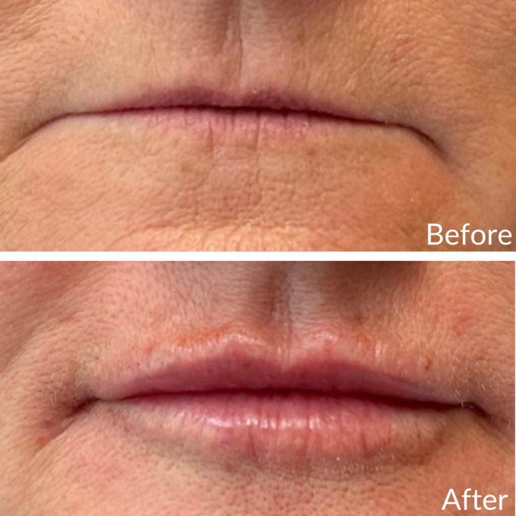 Before and After Image: Lip Filler - front