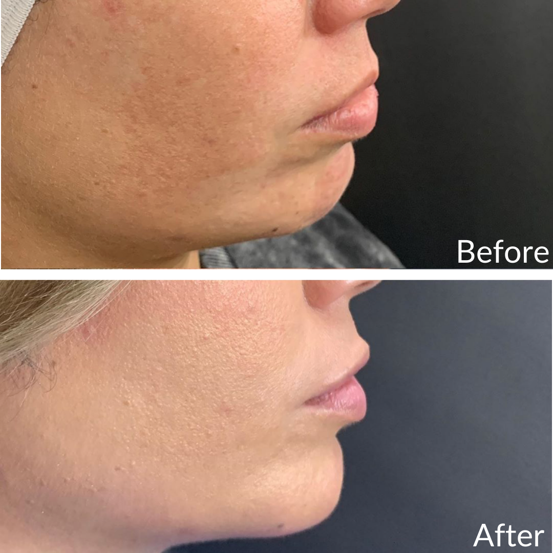Before and After Image: Lip Filler - right-side