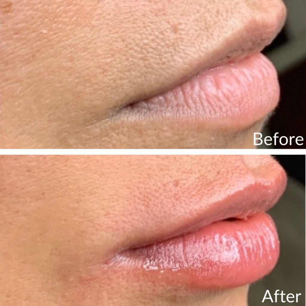 Before and After Image: Lip Filler - right-side