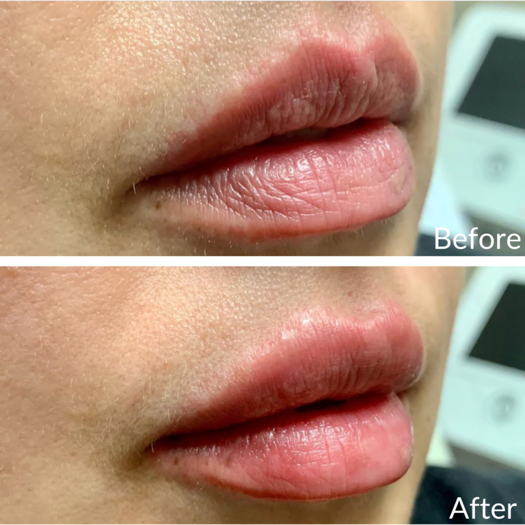 Before and After Image: Lip Filler - right-front-oblique