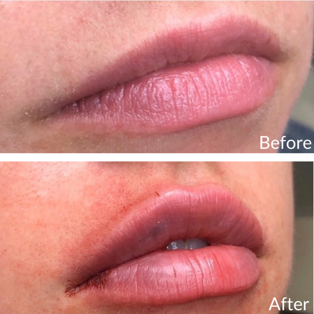 Before and After Image: Lip Filler - right-front-oblique