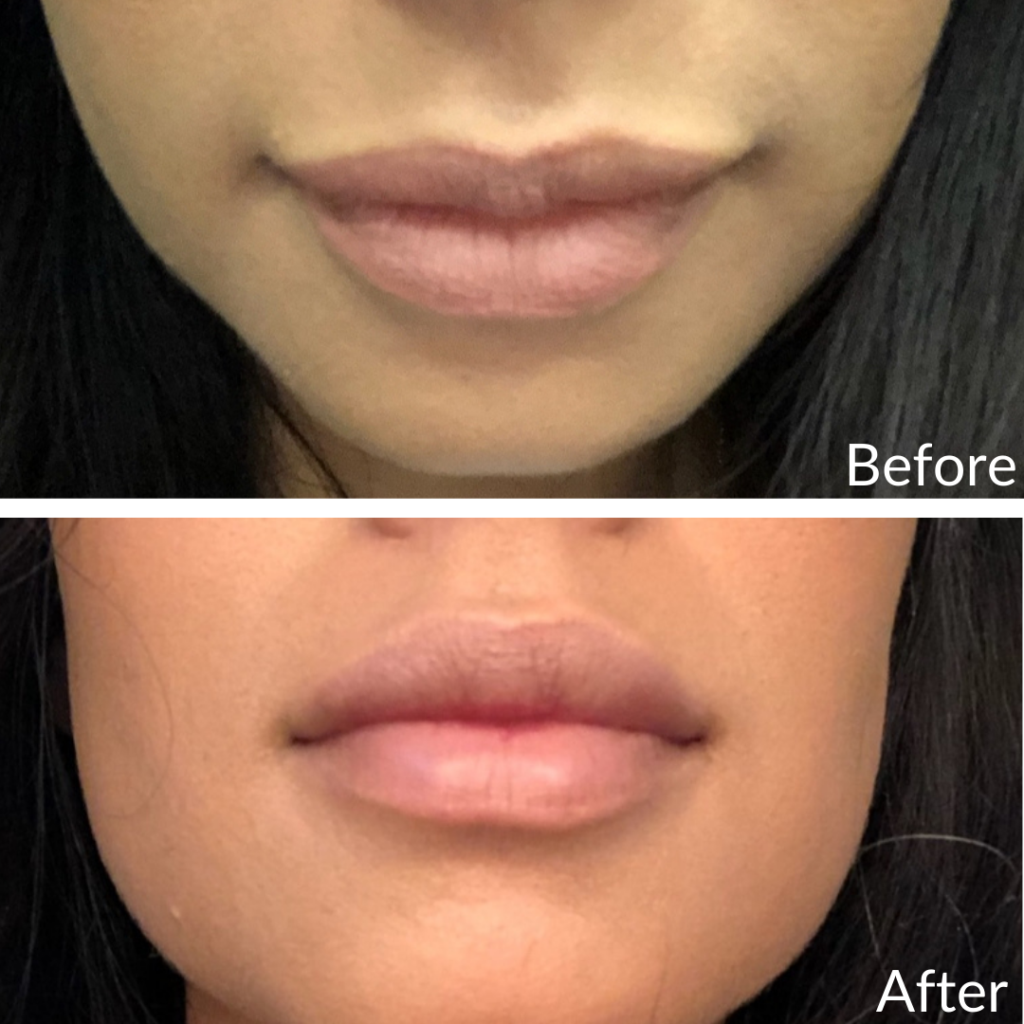 Before and After Image: Lip Filler - front