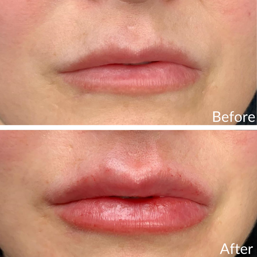 Before and After Image: Lip Filler - front