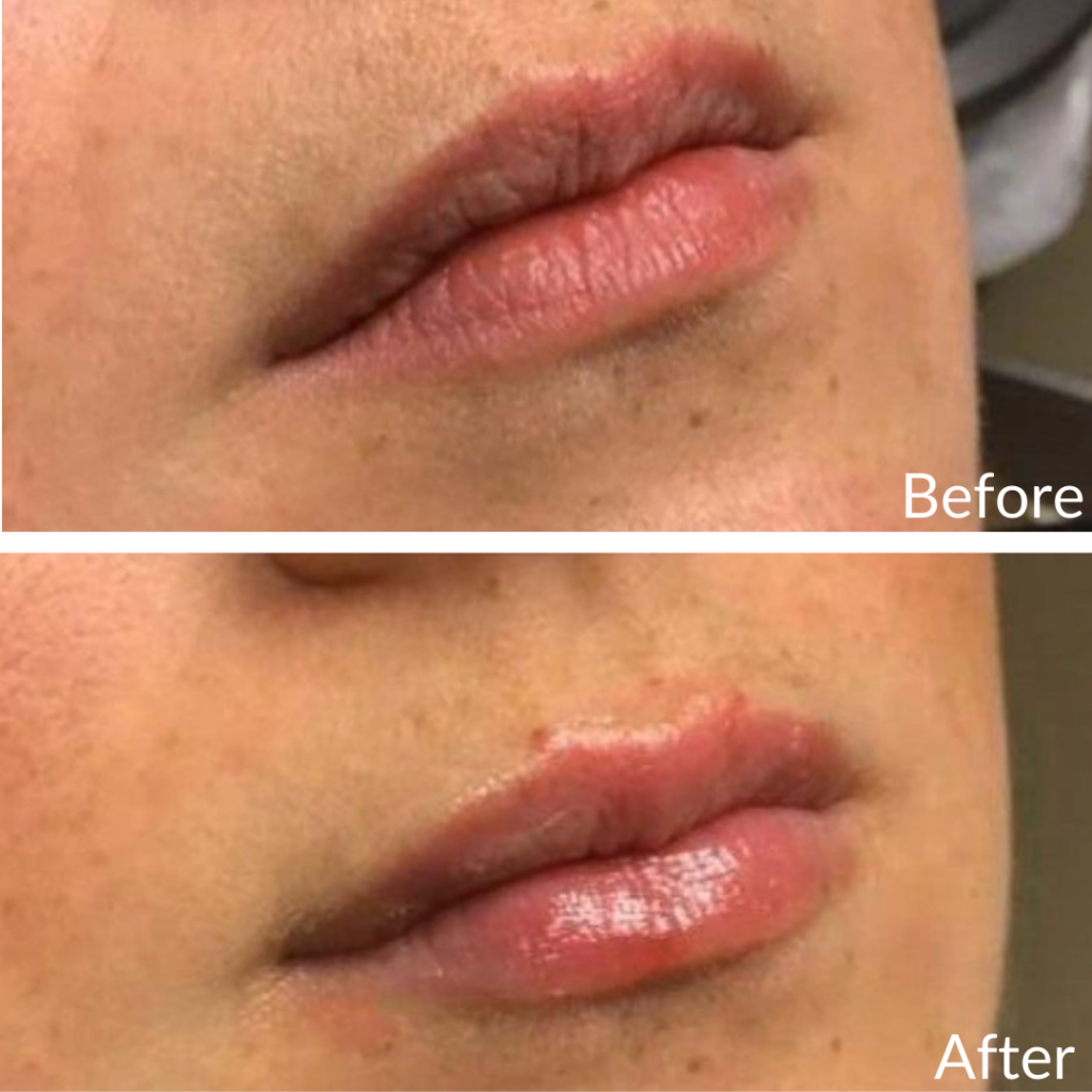 Before and After Image: Lip Filler - right-front-oblique