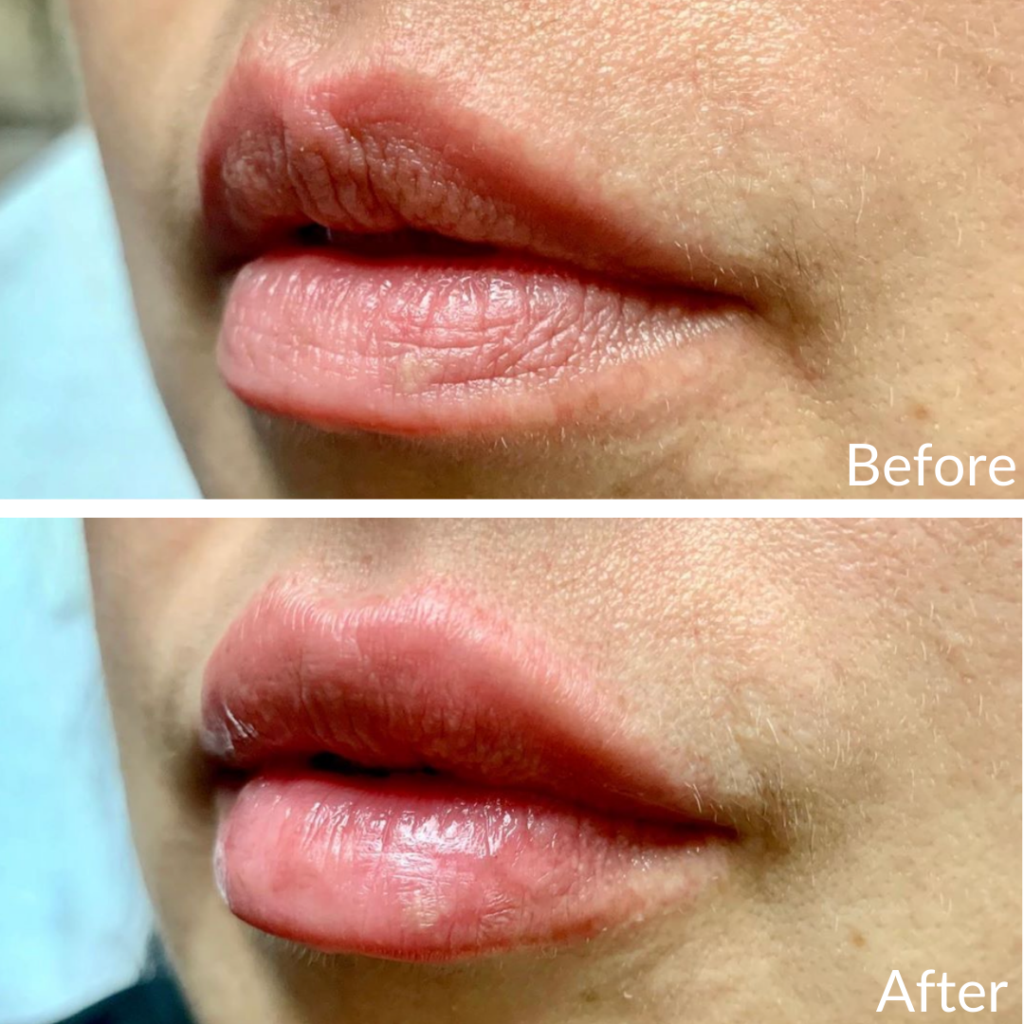 Before and After Image: Lip Filler - left-front-oblique