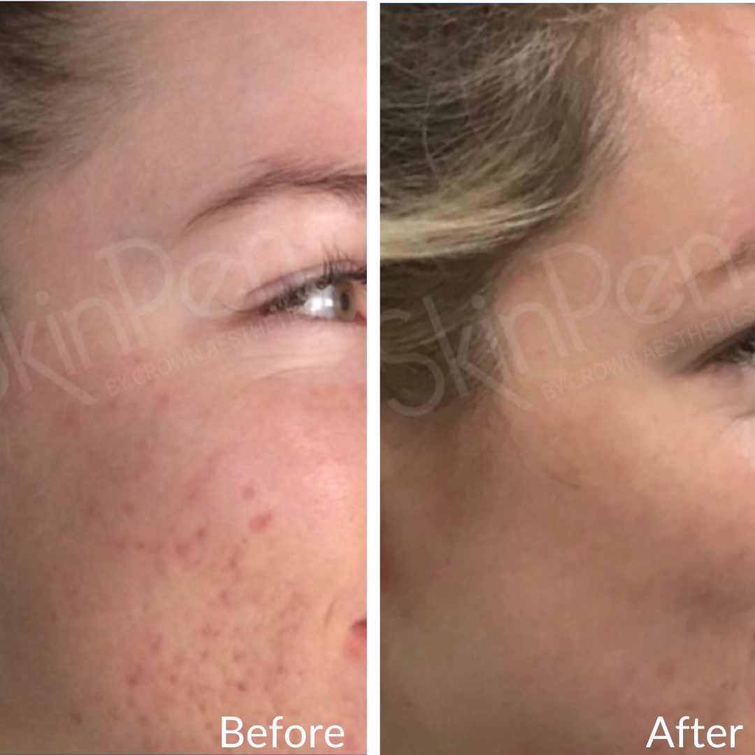 Before and After Image: Microneedling - right-side