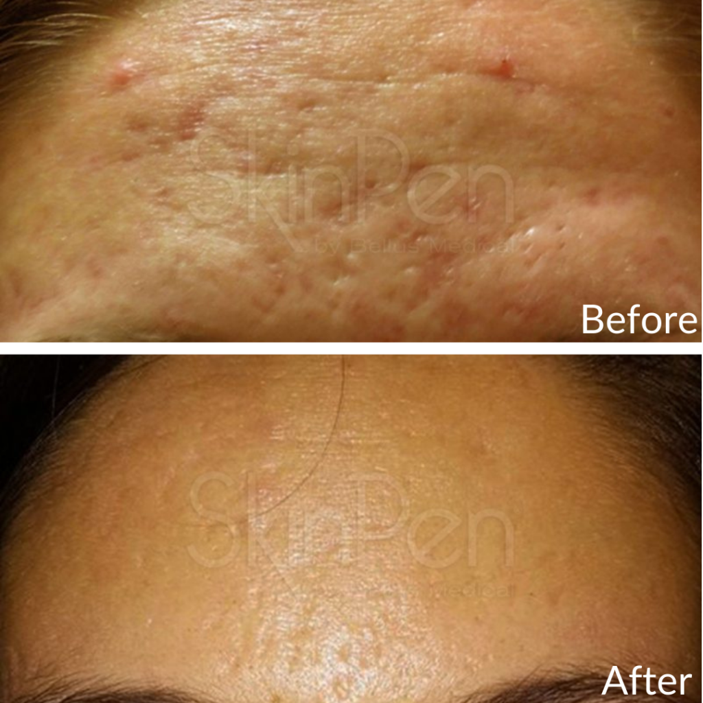 Before and After Image: Microneedling - front